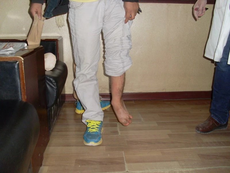 畸形腿、長短腿(圖1)